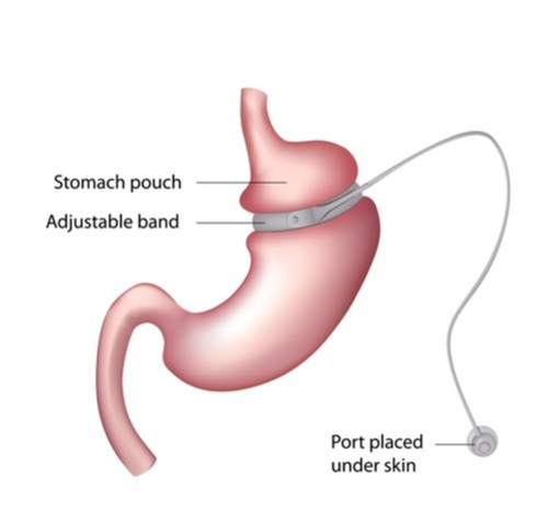 Gastrectomy